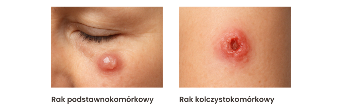 Rak podstawnokomórkowy i rak kolczystokomórkowy - zdjęcia