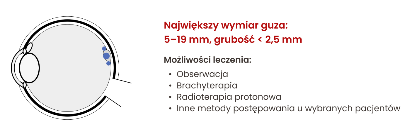 Możliwości leczenia czerniaka błony naczyniowej oka w zależności od jego wielkości