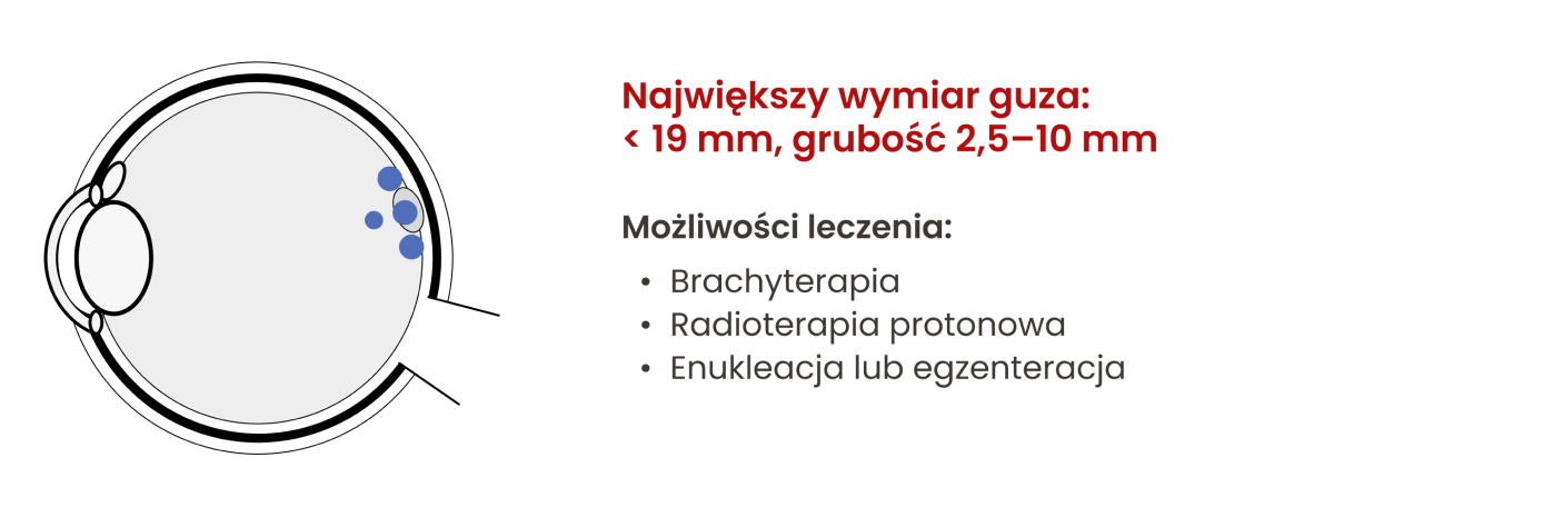 Możliwości leczenia czerniaka błony naczyniowej oka w zależności od jego wielkości