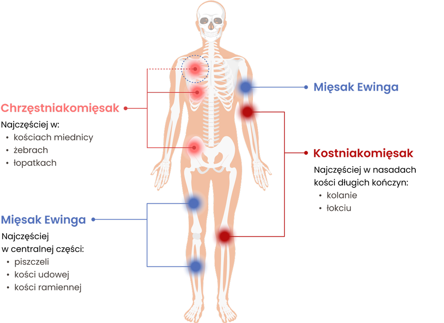Typy mięsaków kości