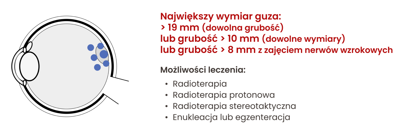 Możliwości leczenia czerniaka błony naczyniowej oka w zależności od jego wielkości