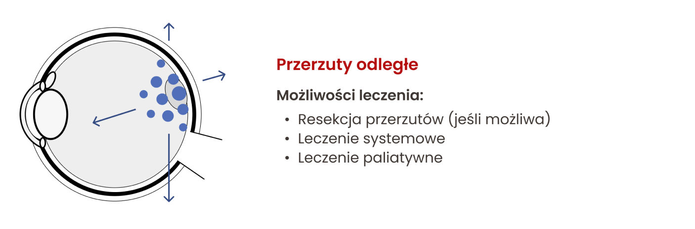 Możliwości leczenia czerniaka błony naczyniowej oka w zależności od jego wielkości