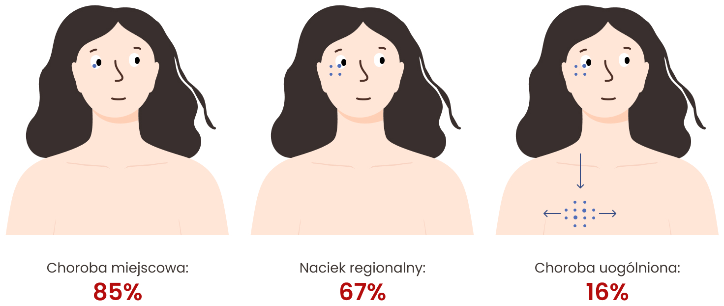 Odsetki 5-letnich przeżyć w zależności od zaawansowania czerniaka oka w momencie rozpoznania: choroba miejscowa – 85%, naciek regionalny – 76%, choroba uogólniona – 16%