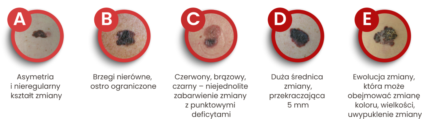 Kryteria ABCDE w diagnostyce czerniaka: asymetria, nierówne brzegi, niejednolity kolor, duża średnica i zmiany w wyglądzie.