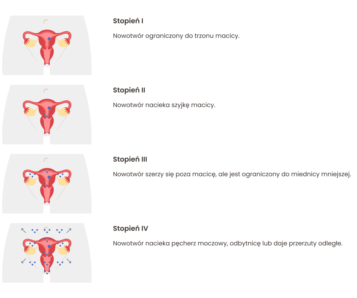 nowotwór endometrium - stopnie zaawanswowania