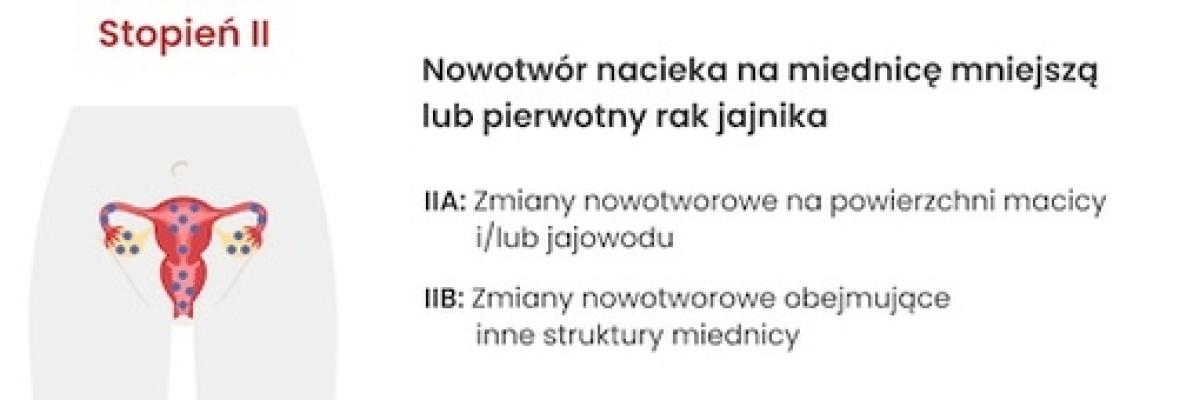 II stopień zaawansowania raka jajnika: Nowotwór nacieka na miednicę mniejszą lub pierwotny rak otrzewnej