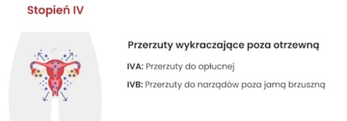IV stopień zaawansowania raka jajnika: Przerzuty wykraczające poza otrzewną