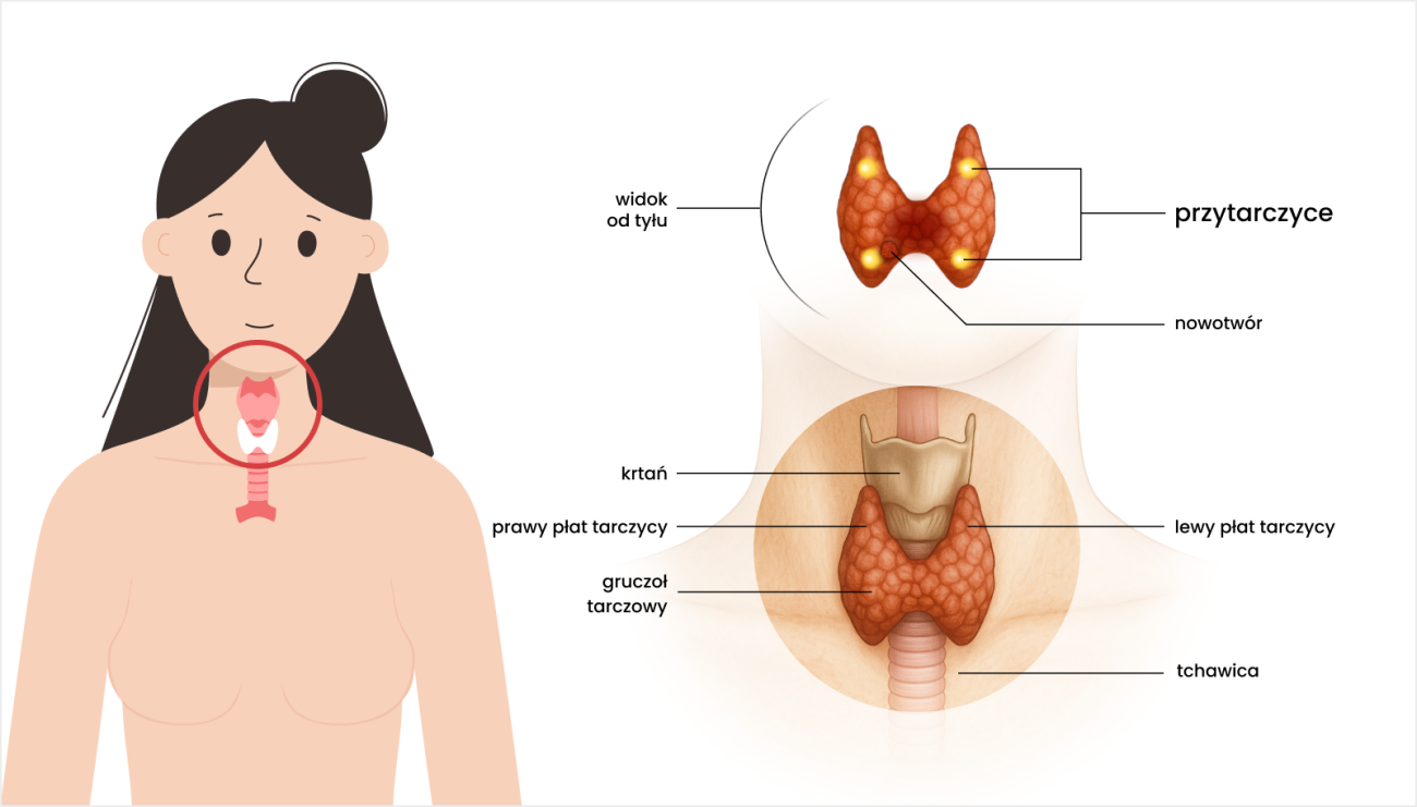 Schemat szyi z tarczycą. Zaznaczona tarczyca oraz przytarczyce znajdujące się z tyłu gruczołu. W jednym z obszarów pokazany nowotwór.
