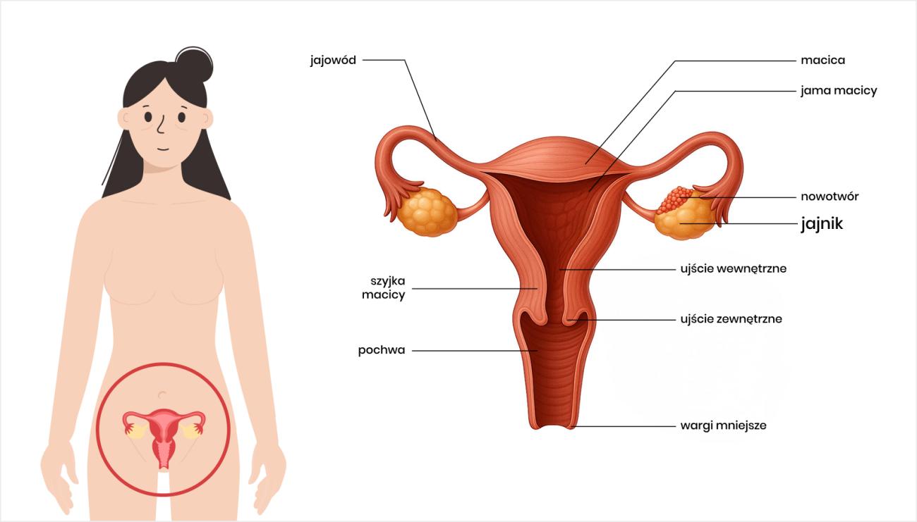 Nowotwór jajnika - lokalizacja.